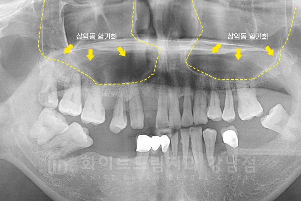 상악동거상술 잘하는치과, 강남역 화이트드림치과 상악동 함기화로 인한 거상술 치료 리뷰 관련 이미지 7
