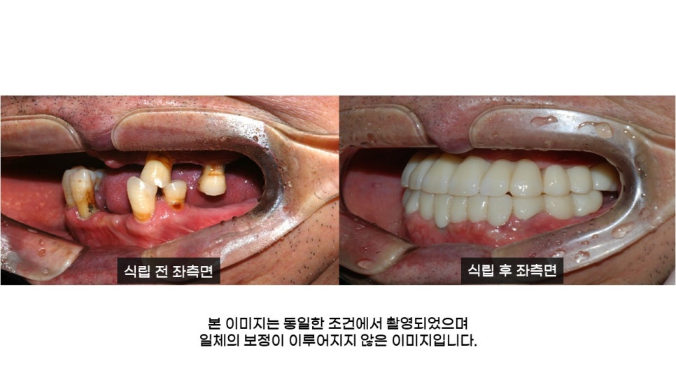 어금니임플란트 수복 및 당뇨환자임플란트 가격, 종류, 통증 관련 이미지 20