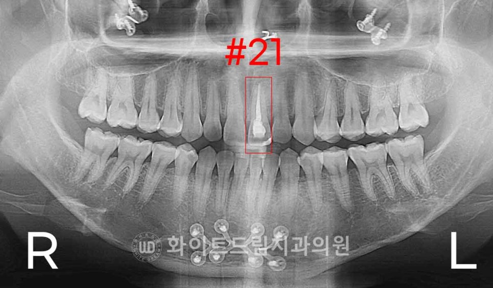 강남역앞니치과 / "신경치료한 치아가 누렇게 변했어요." 신경치료 후 변색된 치아, 어떻게 치료하나요? 관련 이미지 4