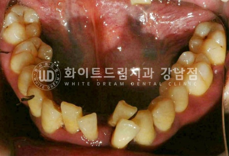 40대 전체임플란트 / 디지털스캔바디를 이용한 전체 임플란트 치료 사례 (Feat. 치주염) 관련 이미지 21