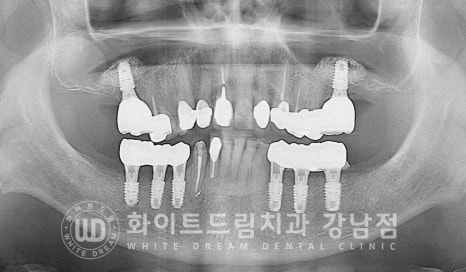 임플란트 개수를 줄일 수 있는 방법? (+치아를 발치한지 오래되었나요?) 관련 이미지 2