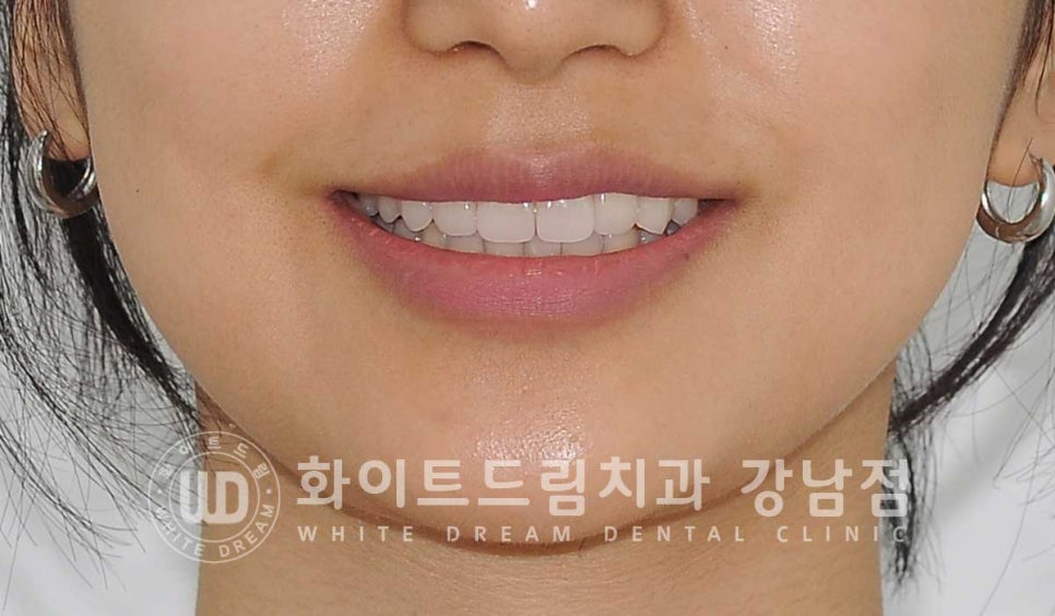 신경치료 후 변색된치아, 라미네이트로 변색과 모양까지 개선! / 강남역화이트드림치과 관련 이미지 9