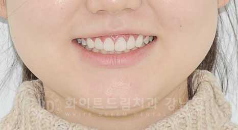 강남역 라미네이트 "치아가 작고 벌어졌어요" 거미스마일 + 벌어진 치아 개선 관련 이미지 18