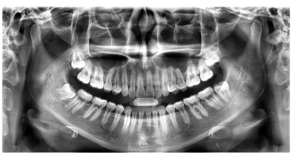 치아교정, 꼭 해야 한다면 미리 알아 두자. 관련 이미지 28