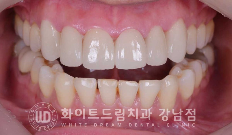 앞니 뻐드러짐 라미네이트 "뻐드러지고 벌어진 앞니" 당일 라미네이트 치료 case 관련 이미지 16