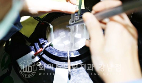 깨진앞니 라미네이트 / 깨지고 누렇게 변한 앞니는? 원데이 라미네이트 치료 사례 관련 이미지 9