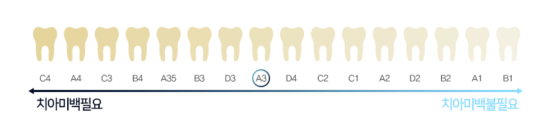 라미네이트 치료에 대해 알아보면? 관련 이미지 20