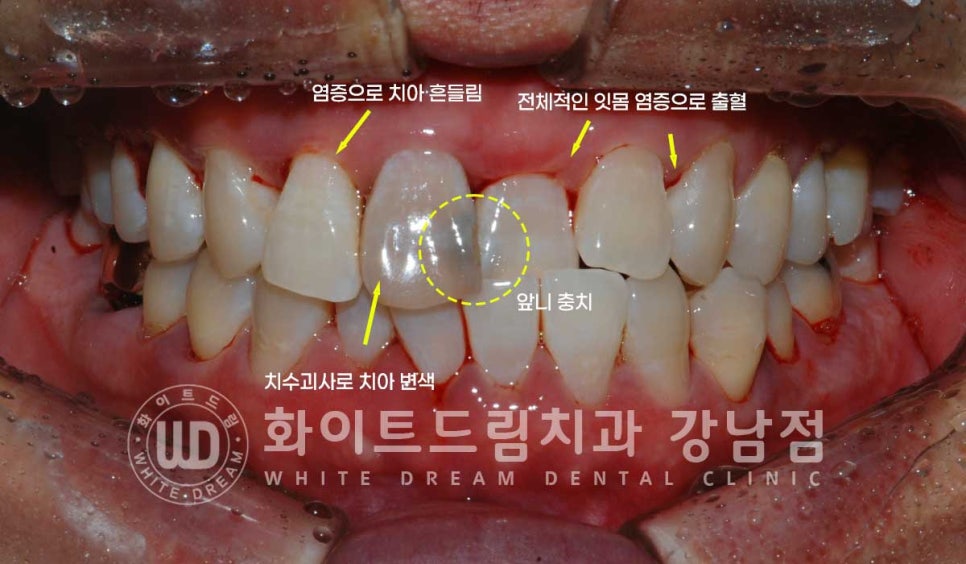 사고당한 앞니치료, "흔들리고 점점 변색돼요." 앞니 임플란트 & 신경치료 관련 이미지 5