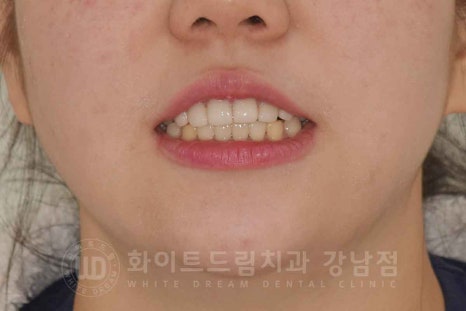 법랑질형성부전증, 라미네이트로 개선해요! / 강남역 라미네이트 치과 관련 이미지 9