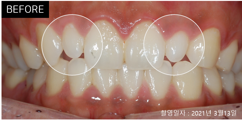 라미네이트 치료에 대해 알아보면? 관련 이미지 13