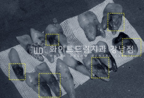 40대 전체임플란트 / 디지털스캔바디를 이용한 전체 임플란트 치료 사례 (Feat. 치주염) 관련 이미지 15