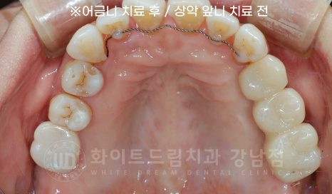 서초동 치과 추천 / "임플란트 개수를 줄이는 식립 방법은?" 강남 화이트드림치과 임플란트 관련 이미지 9