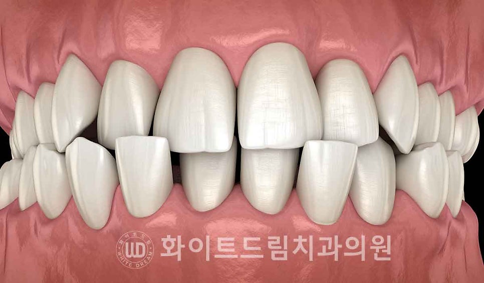 강남옹니라미네이트 "치아가 안으로 들어가서 할머니처럼 보여요" 경미 & 중증도 옹니 라미네이트 치료 관련 이미지 9