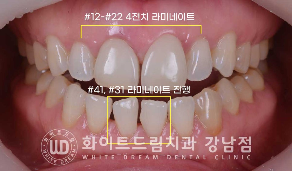 벌어진 앞니 라미네이트 / 50대 시니어 라미네이트 치료 사례 관련 이미지 6