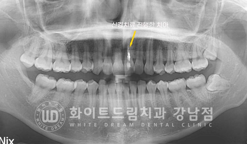 신경치료 후 변색된치아, 라미네이트로 변색과 모양까지 개선! / 강남역화이트드림치과 관련 이미지 5