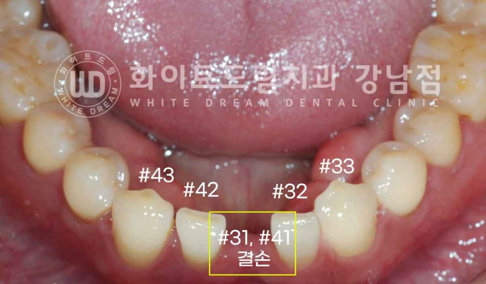 강남역 결손치 "앞니 두 개가 없고, 벌어졌어요" 결손치 치료 방법 관련 이미지 2