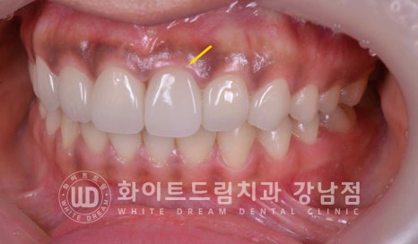 신경치료 후 변색된치아, 라미네이트로 변색과 모양까지 개선! / 강남역화이트드림치과 관련 이미지 3