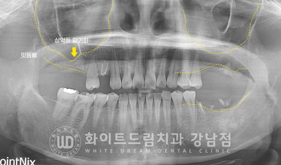 신경치료 후 크라운을 해야 하는 이유 / 크라운을 안 해 부러진 치아 임플란트 치료 case 관련 이미지 12