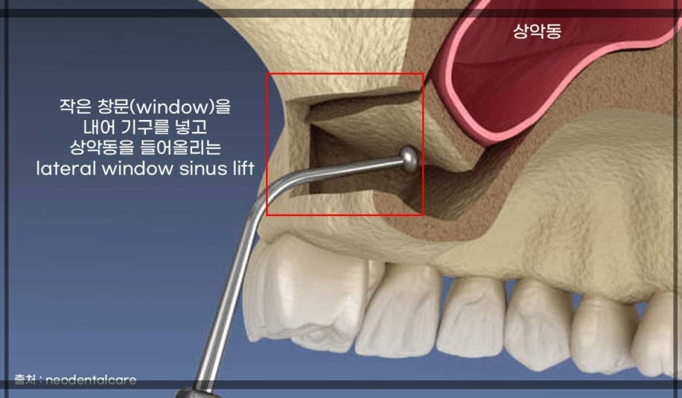 상악동거상술 잘하는치과, 강남역 화이트드림치과 상악동 함기화로 인한 거상술 치료 리뷰 관련 이미지 3