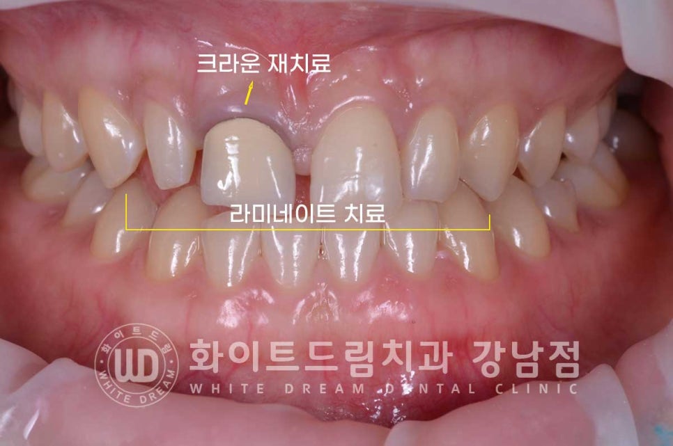 벌어진 앞니라미네이트 / "왜소치로 치아가 벌어졌어요" 치료 사례 관련 이미지 6