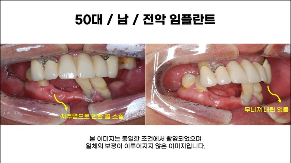 전체임플란트, 치료, 종류, 수술과정과 방법 관련 이미지 1
