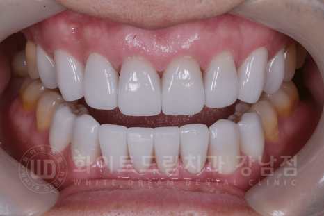 강남역 인근 치과 / 테트라사이클린(tetracycline) 치아 변색 / 라미네이트로 개선! 관련 이미지 16