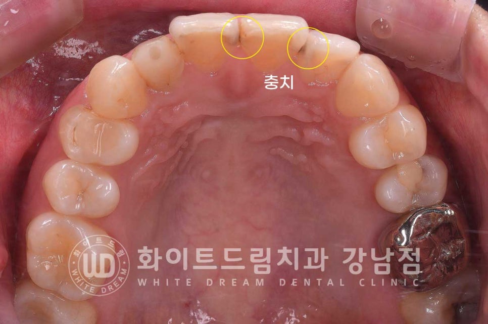신경치료 후 크라운을 씌워야 하는 이유 & 신경치료 후 변색 치료 Case 리뷰 관련 이미지 8