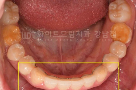 법랑질형성부전증, 라미네이트로 개선해요! / 강남역 라미네이트 치과 관련 이미지 12