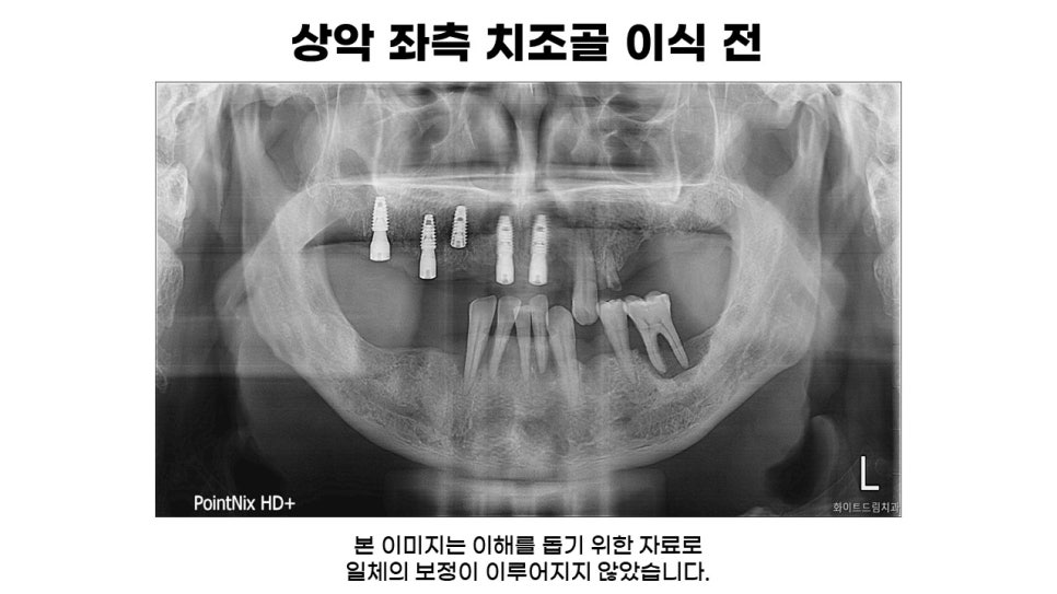 40대임플란트식립후기 및 어금니임플란트 가격, 종류 알아보기 위해 관련 이미지 6