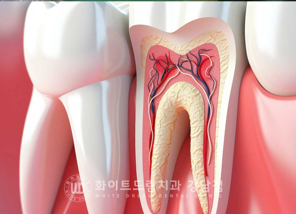 신경치료 후 크라운을 해야 하는 이유 / 크라운을 안 해 부러진 치아 임플란트 치료 case 관련 이미지 2