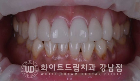 치경부착색 치료 / 라미네이트 vs 올세라믹 치아 삭제량 비교 (Feat. 라미네이트 후 치아미백 가능한가요?) 관련 이미지 18