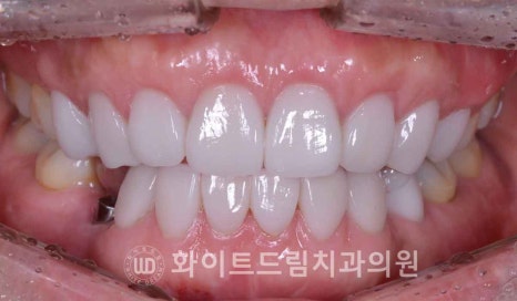 강남옹니라미네이트 "치아가 안으로 들어가서 할머니처럼 보여요" 경미 & 중증도 옹니 라미네이트 치료 관련 이미지 18