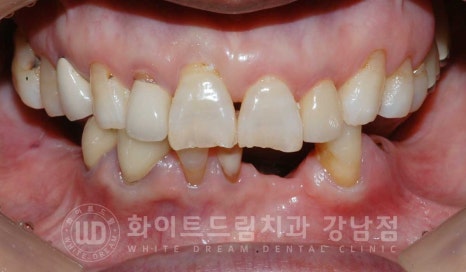 잇몸뼈가 없다는 게 무슨 말일까? "틀니를 오래 사용해서 잇몸뼈가 없대요" 임플란트 잘하는 강남치과 관련 이미지 13