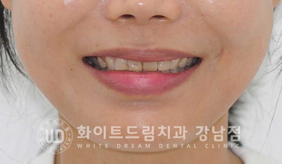 벌어진 앞니 라미네이트 / 50대 시니어 라미네이트 치료 사례 관련 이미지 11