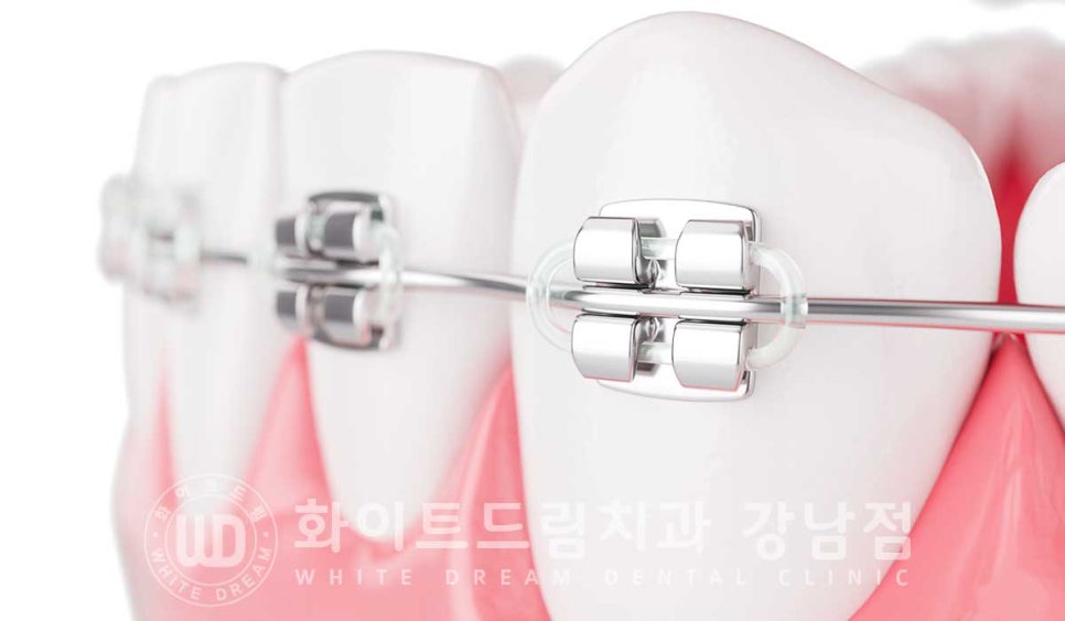 앞니 레진변색 "너무 지저분해 보여요." 라미네이트로 깔끔하게 교체한 치료 사례 관련 이미지 5