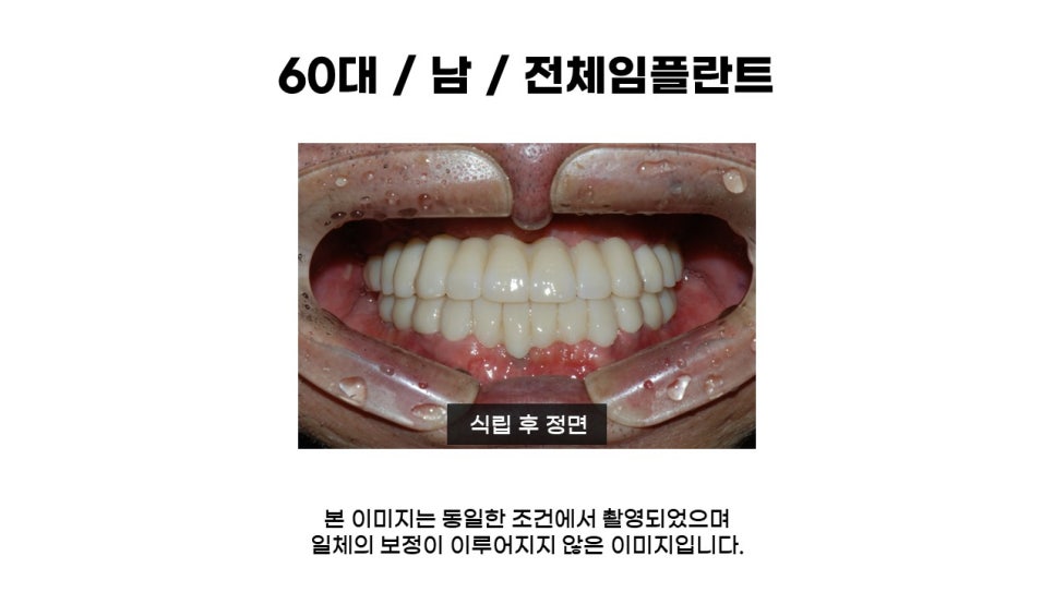 어금니임플란트 수복 및 당뇨환자임플란트 가격, 종류, 통증 관련 이미지 12