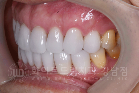 강남역 인근 치과 / 테트라사이클린(tetracycline) 치아 변색 / 라미네이트로 개선! 관련 이미지 18