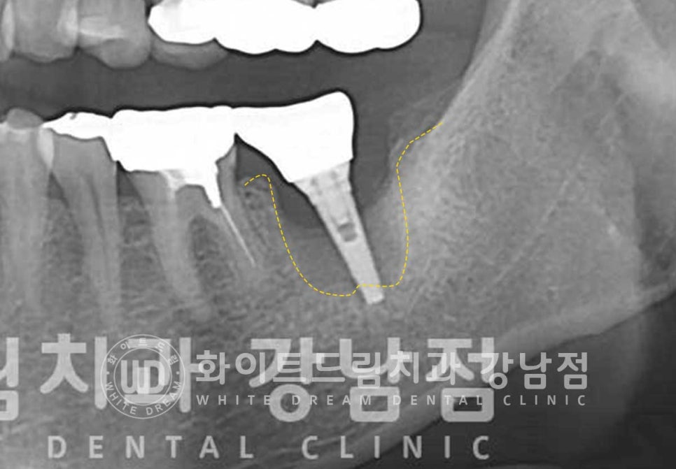 강남역 임플란트재수술 치과 / "임플란트가 흔들려요!" 임플란트 주위염 관련 이미지 2