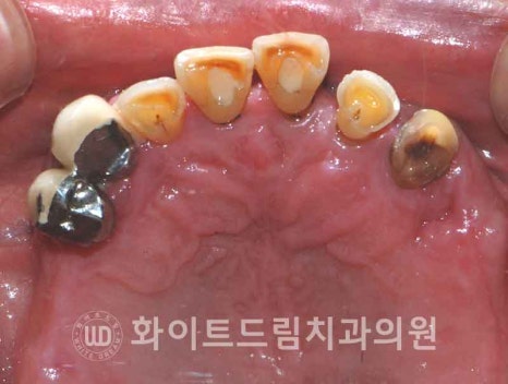 서울전체임플란트잘하는치과, 왜 치주염이 심해지면 반대교합까지 생길까요? (치주염 전체 임플란트 CASE) 관련 이미지 8