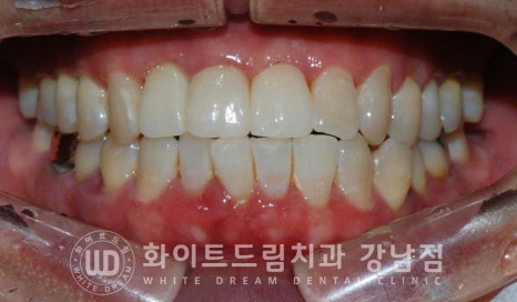 사고당한 앞니치료, "흔들리고 점점 변색돼요." 앞니 임플란트 & 신경치료 관련 이미지 13