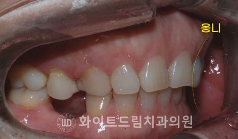 강남옹니라미네이트 "치아가 안으로 들어가서 할머니처럼 보여요" 경미 & 중증도 옹니 라미네이트 치료 관련 이미지 8