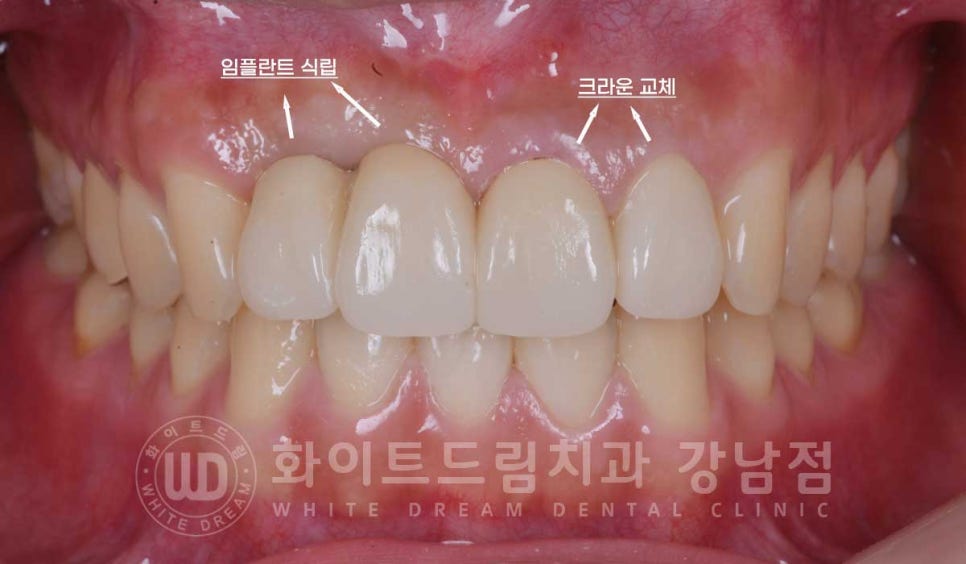 앞니 임플란트 사례 "예전에 심은 임플란트를 뺐어요. 재수술 가능할까요?" 관련 이미지 10