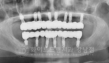 치주염 전체임플란트 치료 사례 / 치아를 흔들리게 만드는 치주염이란? 관련 이미지 20