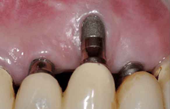 강남역어금니임플란트 치료 시 흔히 동반되는 상악동거상술 (Lateral window 방식), "잘 됐는지 어떻게 확인하죠?" 관련 이미지 7