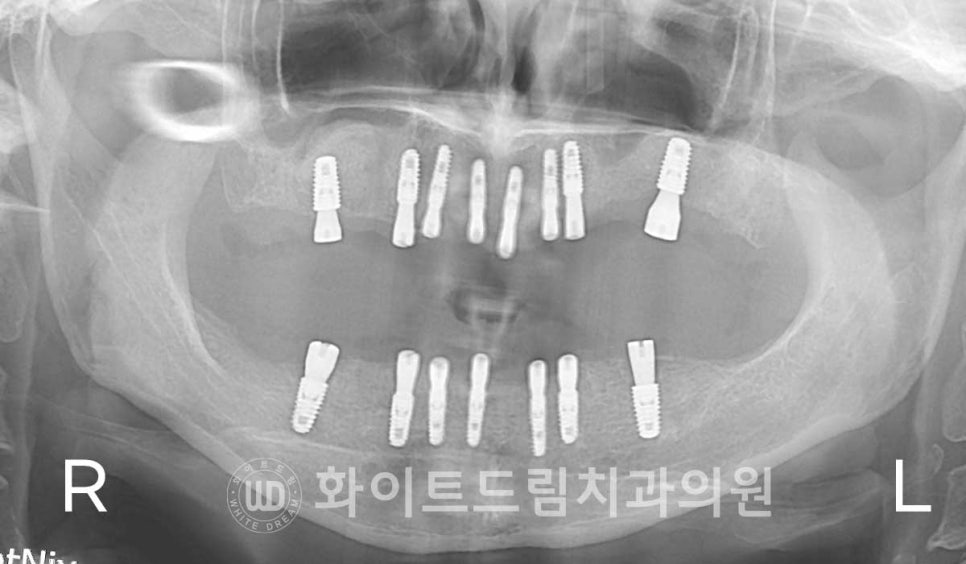 강남역전체임플란트 / 발치 후 즉시 식립, 무조건 누구나 3개월로 끝낼 수 있는 것일까? 강남역화이트드림치과 관련 이미지 14