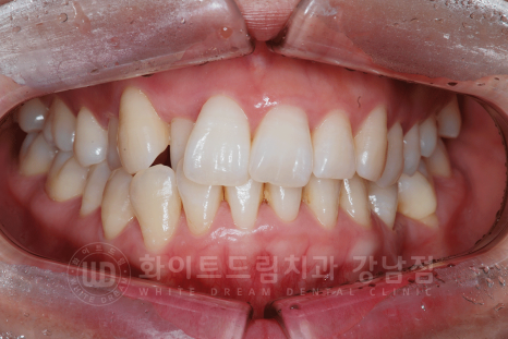 강남 덧니 비발치교정 / 임플란트와 치아교정 동시 진행 case 리뷰. 관련 이미지 24