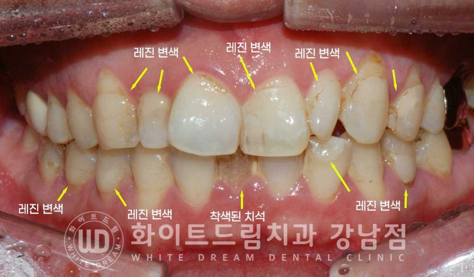 앞니 레진변색 "너무 지저분해 보여요." 라미네이트로 깔끔하게 교체한 치료 사례 관련 이미지 4