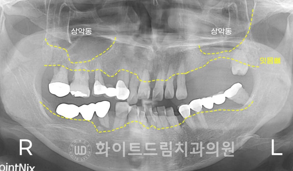 강남역전체임플란트 / 발치 후 즉시 식립, 무조건 누구나 3개월로 끝낼 수 있는 것일까? 강남역화이트드림치과 관련 이미지 8