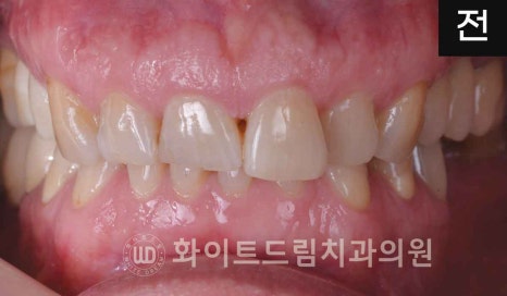 신논현역 당일 라미네이트, "길이가 다른 깨진 앞니" 당일 앞니 라미네이트 치료 과정은? 관련 이미지 16