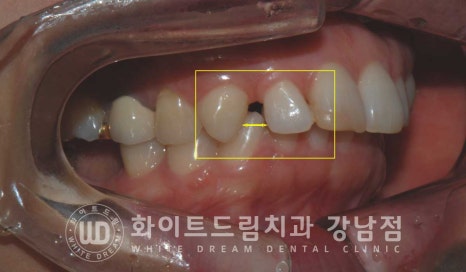 앞니 원데이라미네이트 / 떨어진 앞니 레진 & 벌어진 앞니, 라미네이트로 당일 개선 ★ 관련 이미지 3